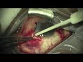 Repair of Conjunctival Erosion Over Tube (Glaucoma Drainage Device)