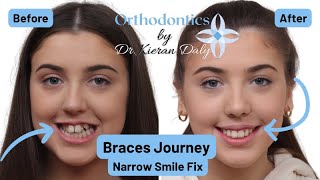 Orthodontist Explains Braces Treatment Journey of Open Bite and Narrow Smile