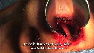 Nasal Septal Cartilage Harvest