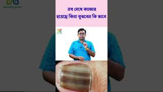 নখ দেখে ক্যান্সার হয়েছে কিনা বুঝবেন কিভাবে ? Nokh dekhe cancer hoyeche ki na bujhbe ki bhabe ?