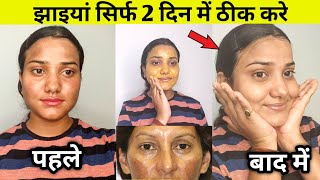 झाइयों से छुटकारा पाये सिर्फ़ 2 दिनों में ॥ Reduce Melasma, Pigmentation, Discolouration, Blackspots