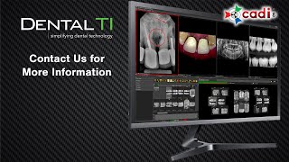 2-Minute Demo on CADI Advanced Dental Imaging Software | Dental TI