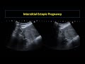 ultrasound of ectopic pregnancy made easy