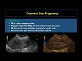 ultrasound of ectopic pregnancy made easy