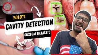 YOLO11 Dental Cavity Detection | Train AI with Custom Dataset