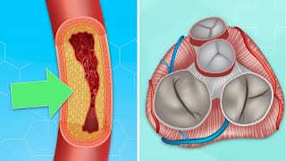 Coronary Artery Disease & Heart Valve Surgery: What Should Patients Know?