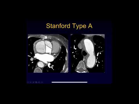 Can you see aortic dissection on CT?