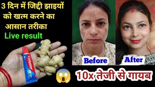 अदरक से झाइयां हटाने का कमाल का तरीका II Reduce Melasma, Pigmentation, Discoloration, Blackspots