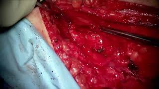 Video 207 1 Surgical Treatment for Painful Sensory Neuroma