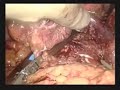 educational video for hand assisted distal pancreatectomy