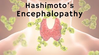 Thyroid Disease as a Cause of Psychosis: Hashimoto's Encephalopathy