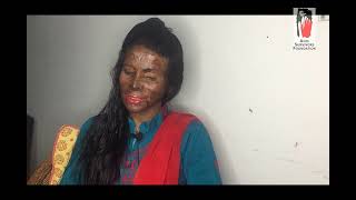 Sumi Akter Riya a Acid Survivor