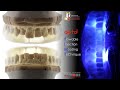 Flowable Injection MoldingTechnique to  increase VDO in Deprogrammed Passively Retruted Position