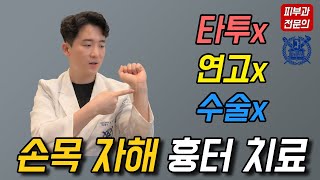 자해 흉터 없애는 법, 더 이상 가리지 마세요. /닥터피부광 /자해 흉터 치료/