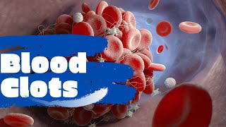 Clots explained by Dr.Earle