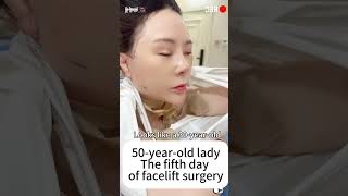 50-year-old woman had facelift surgery 5 days later, she looks much younger