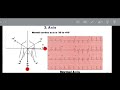 تفسیر خواندن نوار قلب به روشی آسان ecg interpretation made easy