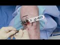 ibalance® hto implant surgical technique