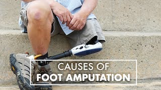 Amputation of The Foot | Dr. Reza Mobarak | Top10MD