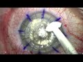 manual dalk corneal transplant