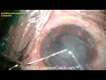 cataractcoach™ 2083 cataract quiz how do you manage zonular dialysis