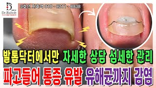 🔨내성 발톱🔨아프고 불편한 발톱... 자세한 상담과 섬세한 관리는 발톱닥터에서! 😭 [발톱닥터] #내성발톱 #내성발톱교정 #내성발톱관리 #지축역