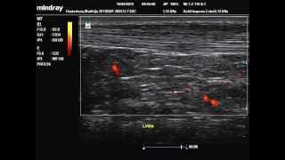 Achilles Tendon Long Axis View Ultrasound - Hypervascularity in Kager's Fat