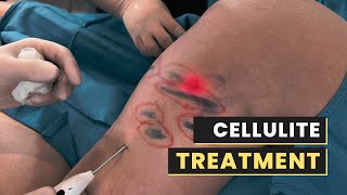 CONFIRM YOUR CELLULITE IS GONE WITH AVELI | Dr. Jason Emer