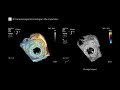 transcatheter mitral valve in valve procedure after bioprosthetic valve failure