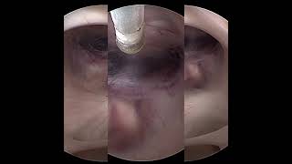 Endoscopic third Ventriculostomy in a patient with  Aqueduct Stenosis that and shunt failure