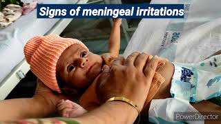 CNS Examination in children | Signs of meningeal irritation | Pediatrics