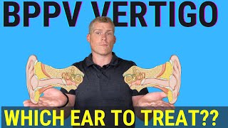 How to tell which ear to treat for BPPV (Using Half Somersault Maneuver)