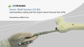 Femur, Shaft - Fracture 32B2 - Intramedullary Nailing With the Expert Lateral Femoral Nail (LFN)