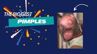 Popping Tons Of Blackheads Part 01