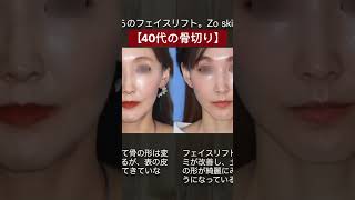 【40代の骨切り】骨切りしたらたるむ？ #美容整形 #やまぐち先生 #骨切り#フェイスリフト#たるみ#リゾナスフェイスクリニック東京