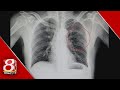 Health Spotlight | Fixing broken ribs