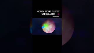 Laser surgery of kidney stone: Instant removal of stone by high power HOLMIUM laser!