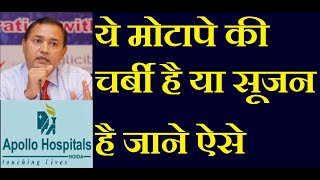 कैसे जाने की ये मोटापे की चर्बी है या सूजन है | Differentiation between feet Swelling or Excess Fat