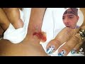 popping huge blackheads and giant pimples best pimple popping videos