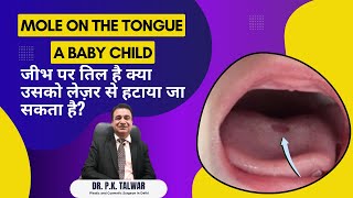 Mole on tongue, can it be removed with laser? Get Best consultation from Dr Pk Talwar in Delhi.