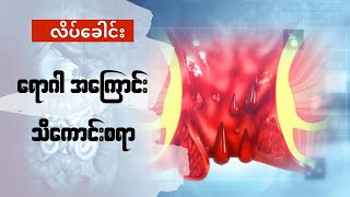 လိပ်ခေါင်းရောဂါအကြောင်း သိကောင်းစရာ #lynnpharmacy