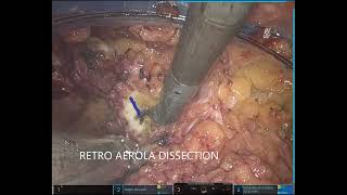 383 Uniportal Robotic Assisted Mastectomy (U-RABS) Dr Jagdishwar Goud Gajagowni