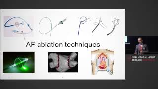 Catheter Ablation for Atrial Fibrillation - Dr Anderi Catanchin