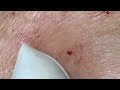 big cystic acne blackheads extraction blackheads u0026 milia whiteheads removal pimple popping 1576