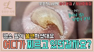 휘어져있는 발톱! 평소 불편하셨다는데 어디가 찌르고 있던걸까요? 리쌤의 스케일링은 계속된다! ingrown toenail - Fresh Foot 풋풋한리쌤 성수점 / 평내호평점