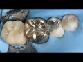 미세현미경을 이용하여 촬영한 치아 신경치료의 과정 feat. 오버레이 크라운 수복 endodontic treatment under dental microscope