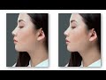 why your jawline never looks sharp facial aesthetics 101 the jaw ramus