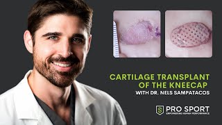 Cartilage Transplant of Kneecap