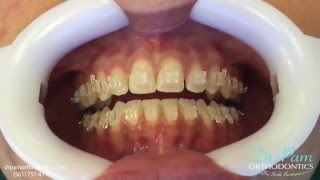 Braces: Replacing / Placing a Bracket