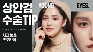 [강남 디바성형외과] 김종명 원장님이 알려주는 상안검수술 TIP!